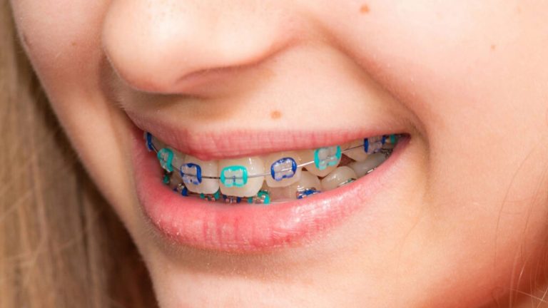 Best Braces Colors Wheel